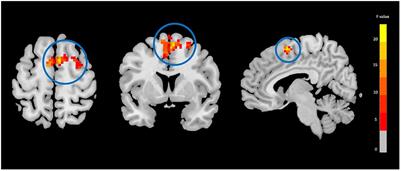 Treatment effects of N-acetyl cysteine on resting-state functional MRI and cognitive performance in patients with chronic mild traumatic brain injury: a longitudinal study